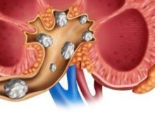 احتمال ایجاد سنگ کلیه در بیماران دیابتی و فشارخون/ برخی داروها سنگ‌سازند