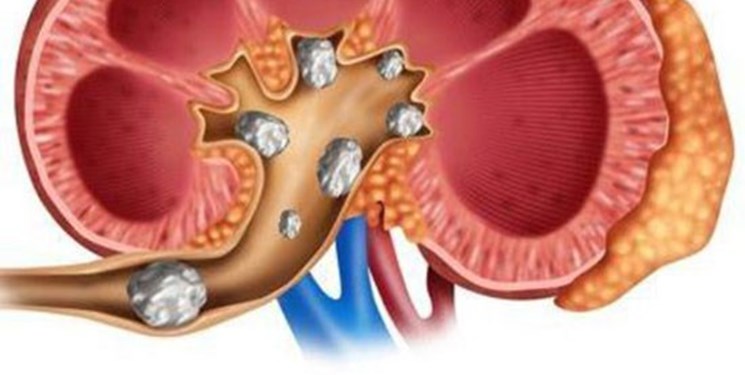 احتمال ایجاد سنگ کلیه در بیماران دیابتی و فشارخون/ برخی داروها سنگ‌سازند